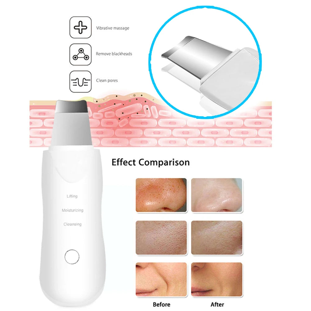 Espátula Ultrassônica Facial — Limpeza Profunda e Esfoliação